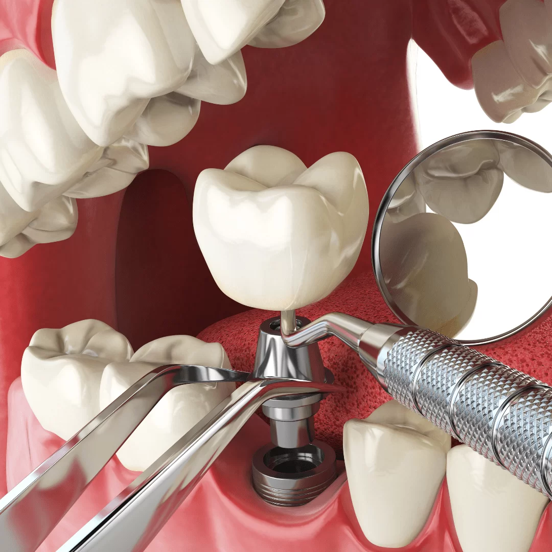 implante-dentario-niteroi-icarai-dra-carina-lyra