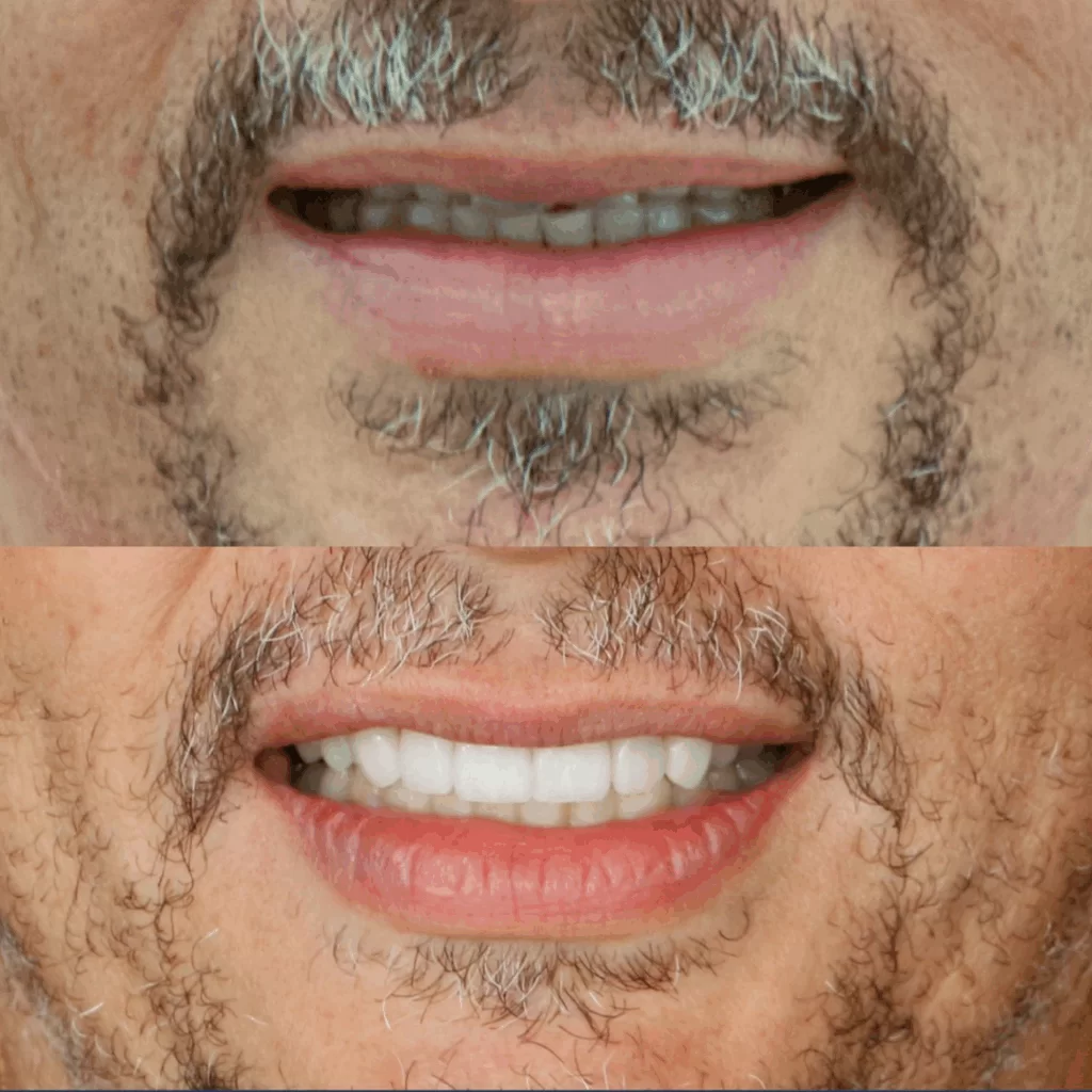 Facetas Dentárias em Niteroi - Dra. Carina Lyra
