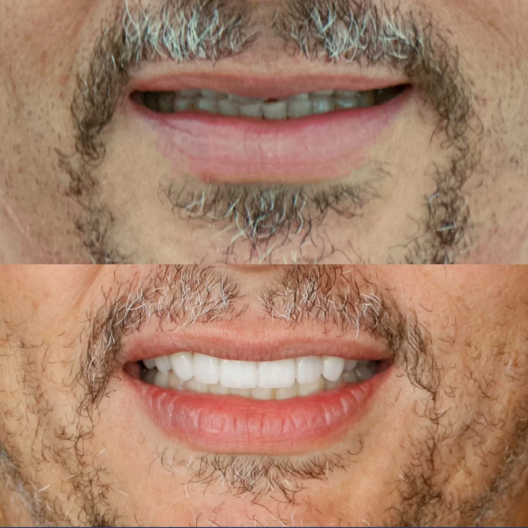 Facetas Dentárias em Niteroi - Dra. Carina Lyra