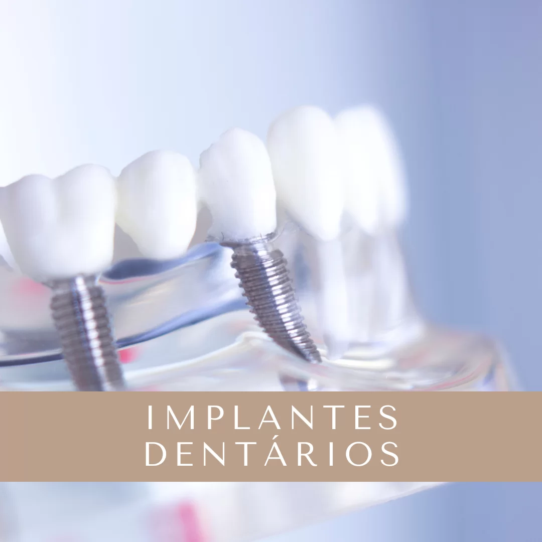 Implantes Dentários 03 - Dentista em Icaraí