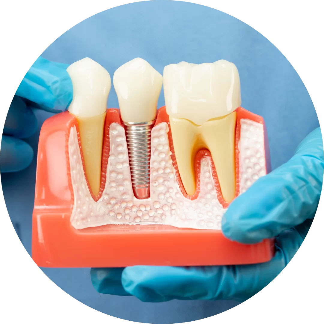 Card Tratamento de Canal V2